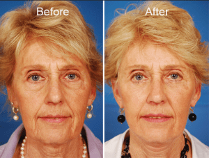 Michael Reilly - Pre-Post 2