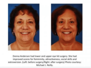 Michael Reilly-Preoperative-Postoperative photos